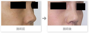 症例写真：鼻中隔延長術プラスＩ型シリコンプロテーゼ2