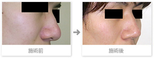 症例写真：鼻尖縮小術（コンプリートリダクション法）プラス鼻骨幅寄せ術2
