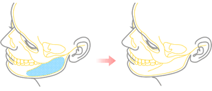 図：下顎体部削除法